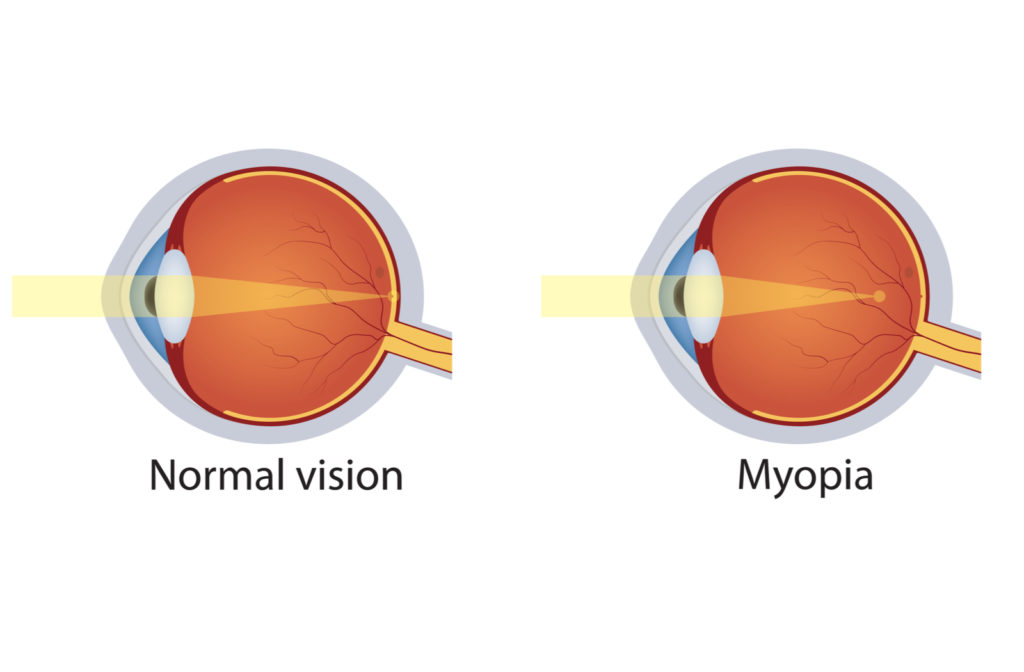 Illustration of normal vision versus myopia with types of light going through eye