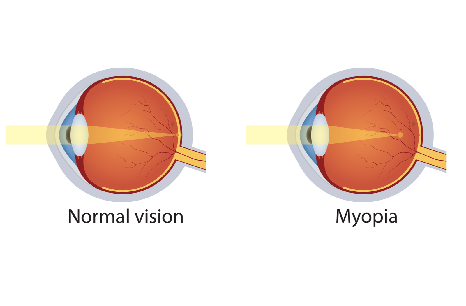 What Are the Different Types of Myopia?