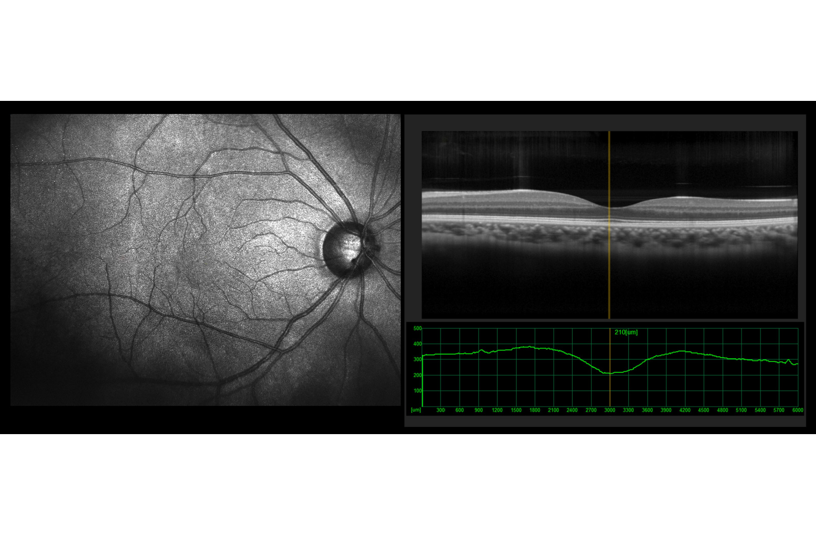 Example OCT scan showing the retina and macula.