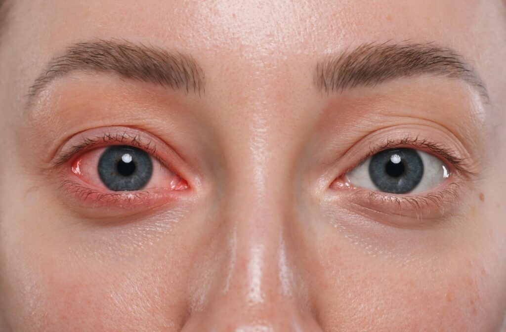 A person looks into the camera with only their eyes showing and one of their eyes is red and swollen.