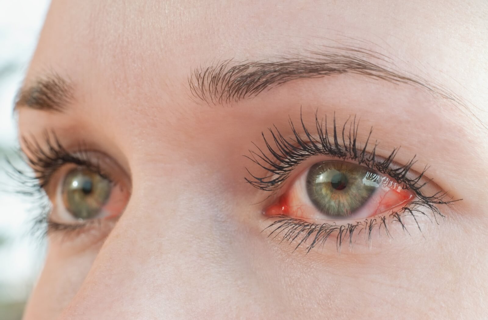 A close up of a person's stinging, red eyes.