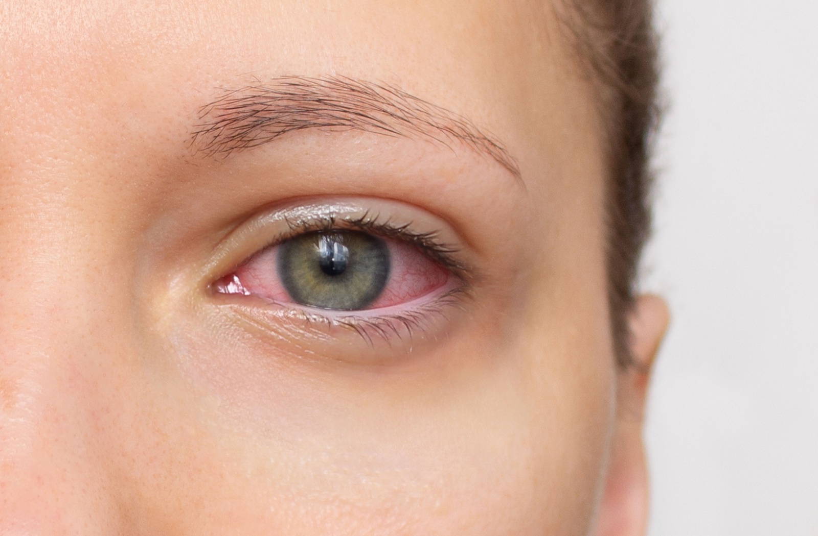 Close-up of a person's eye which is red from dryness and irritation.