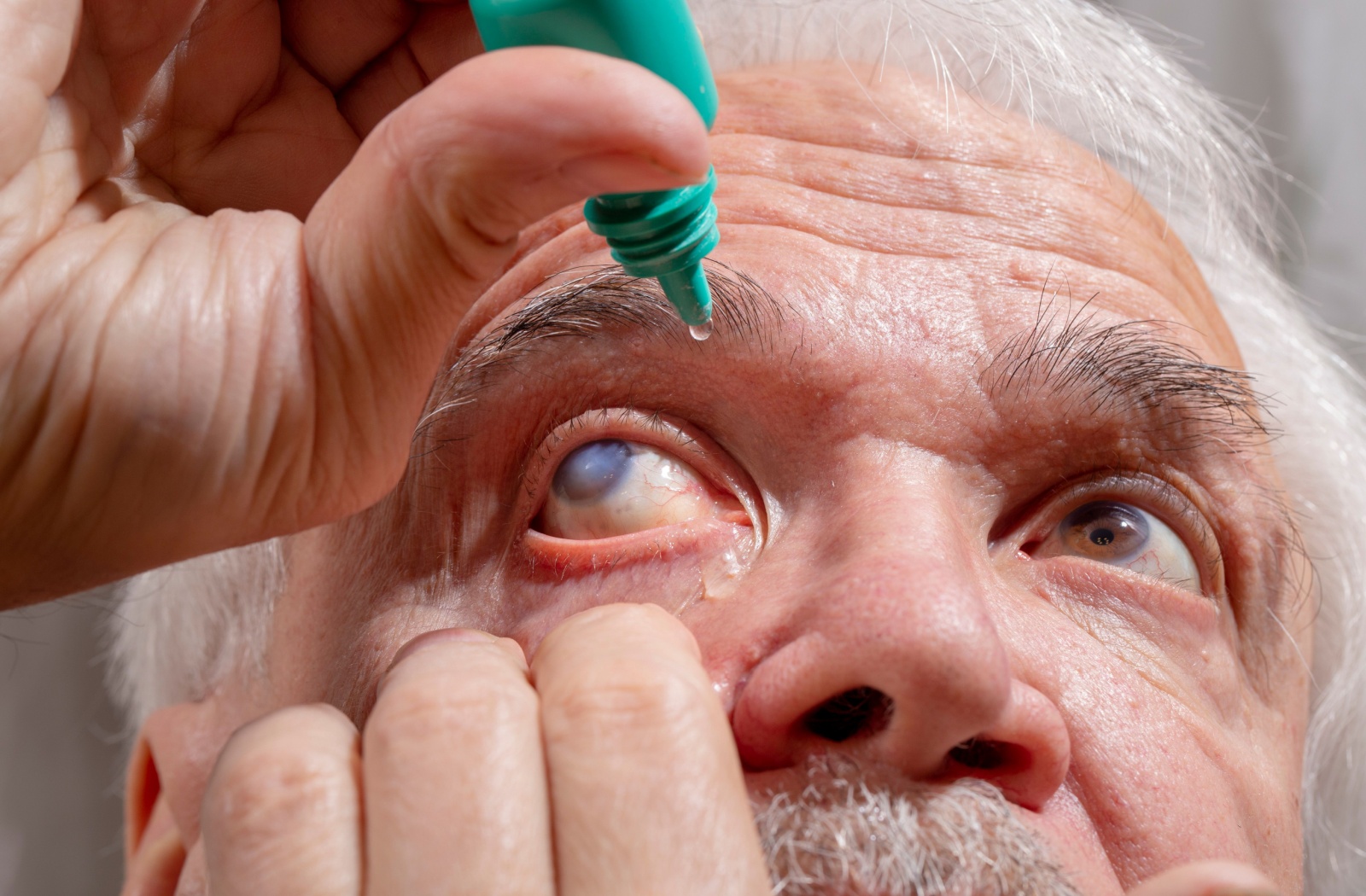 Elderly man applying eye drops, with visible cataract in one eye.