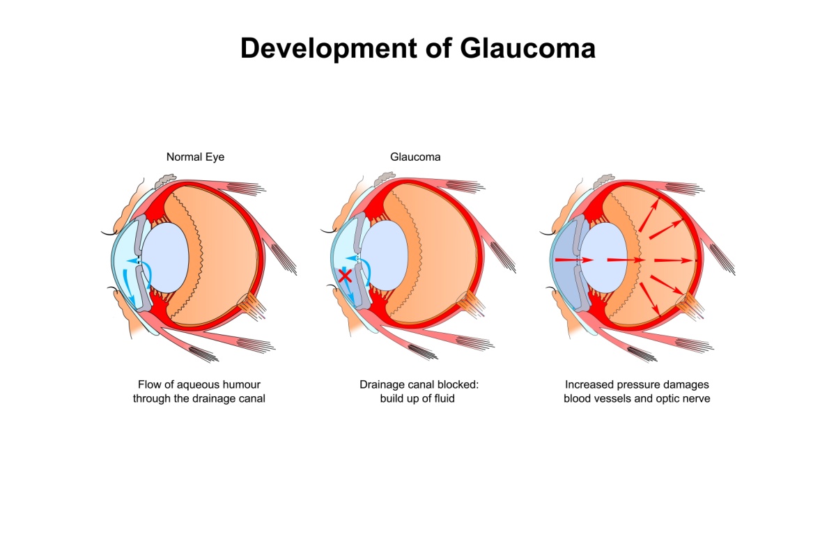 Medical diagram showing three stages of glaucoma development from normal aqueous humor flow through drainage canal blockage to increased pressure damaging blood vessels and optic nerve.