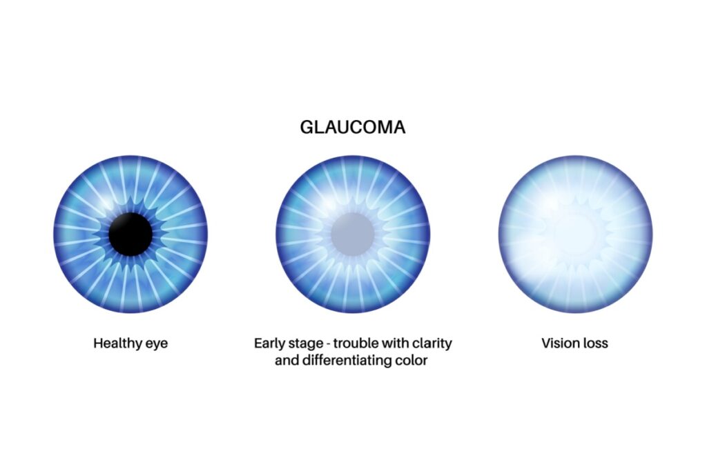 Visual comparison showing progression of glaucoma from healthy eye view to early stage with blurred clarity and color differentiation to advanced vision loss.